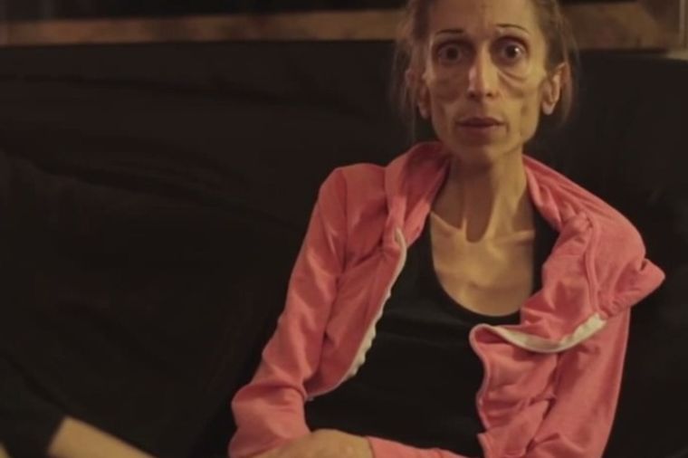 Vapaj anoreksične glumice: Umirem, imam samo 18 kg! (VIDEO)