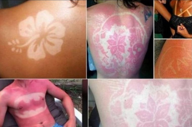 Svesno gore svoju kožu! Rezultat: Opekotine od sunca kao tetovaža! (FOTO)