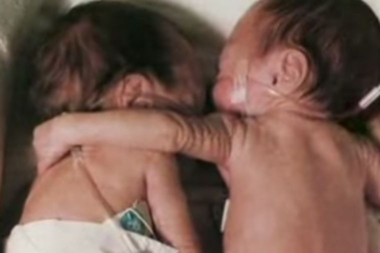 Prevremeno rođena beba zagrlila bliznakinju na samrti: Ono što se desilo šokiralo je sve! (VIDEO)