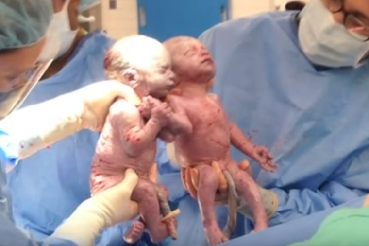 One su raznežile svet: Evo kako sada izgledaju sestre koje su rođene zagrljene! (VIDEO)