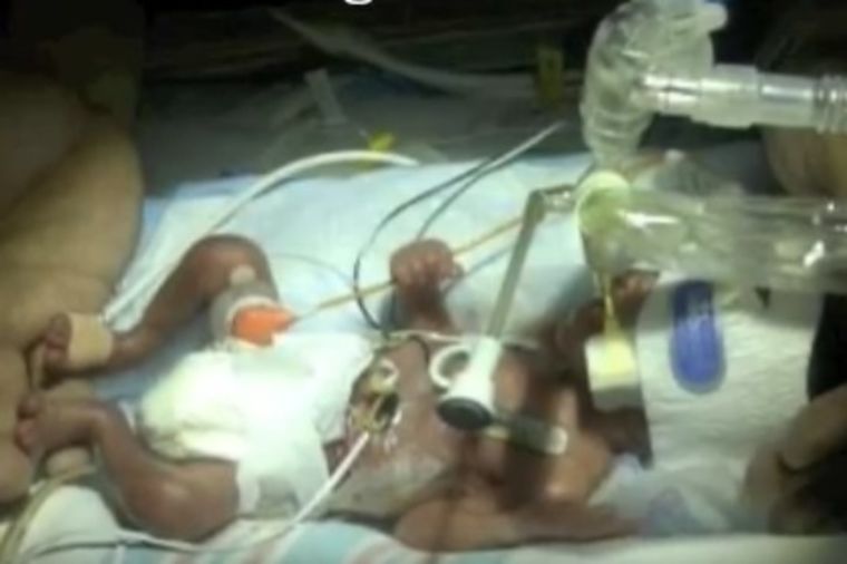 Mislili su da neće preživeti: Beba rođena 4 meseca pre termina pobila medicinu! (VIDEO)