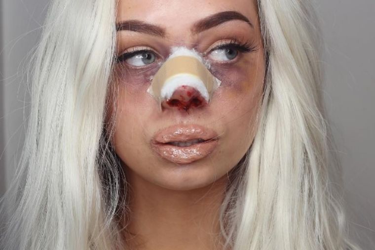 Jeziva cena plastične lepote: Ovako lice izgleda nakon estetskih operacija! (FOTO, VIDEO)