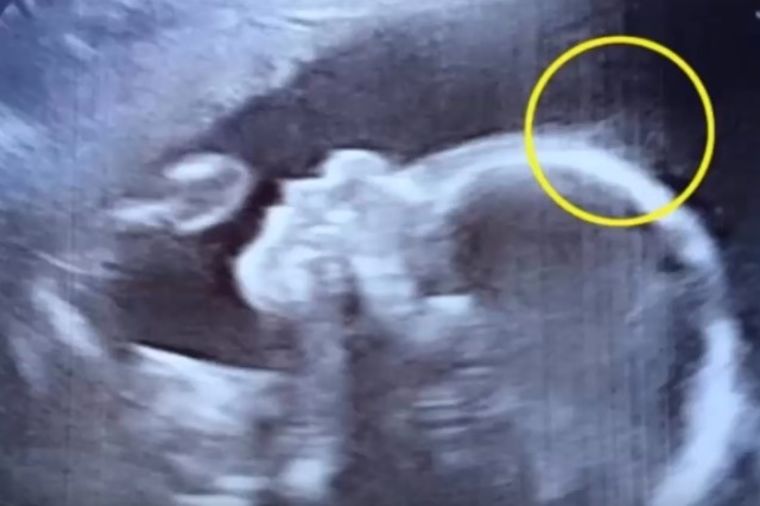 Trudnica otišla na kontrolu kod doktora: Nije verovao svojim očima šta vidi na ultrazvuku! (VIDEO)