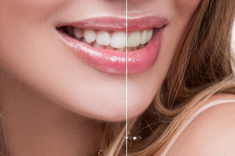 Budite ponosni na vaš osmeh: Iskoristite popust i u nekoliko koraka izbelite zube kod kuće!