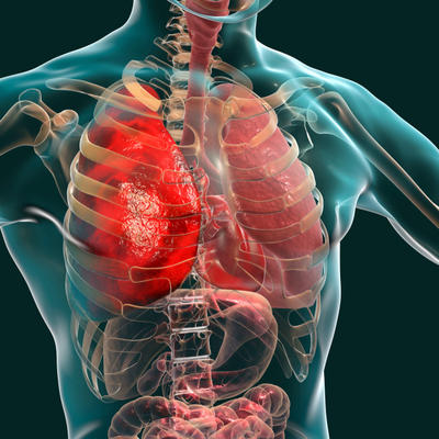 Ovo su prvi znaci upale pluća: Ova hrana oporavlja telo koje se bori sa pneumonijom! (JELOVNIK)