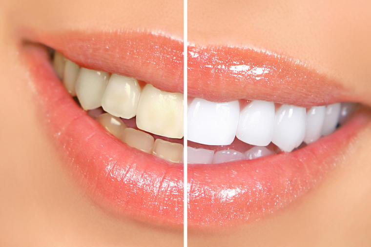 Bez hemije i uništavanja gleđi: Pet potpuno prirodnih i efikasnih načina da izbelite zube!