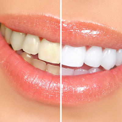Bez hemije i uništavanja gleđi: Pet potpuno prirodnih i efikasnih načina da izbelite zube!