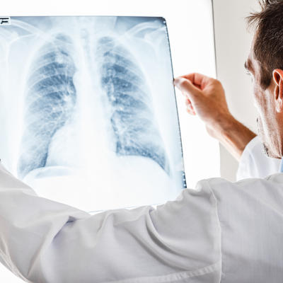 ISPRAVKA: Žutica nije jasan signal da se u telu razvija rak pluća