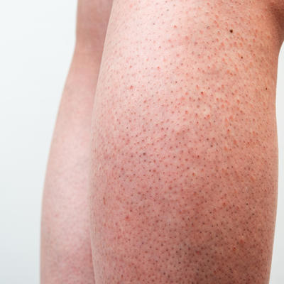 Posledica infekcije ili genetika?Jagodičasta koža na nogama je čest problem, a evo kako se rešava!
