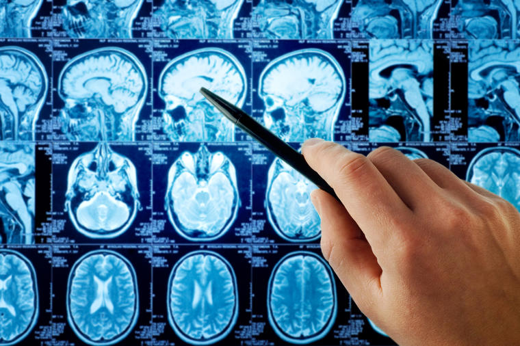 8 simptoma tumora na mozgu: Tihi signali koje svi ignorišemo i pripisujemo drugim stvarima!