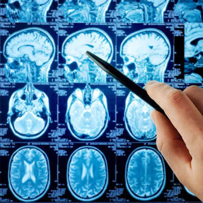 8 simptoma tumora na mozgu: Tihi signali koje svi ignorišemo i pripisujemo drugim stvarima!