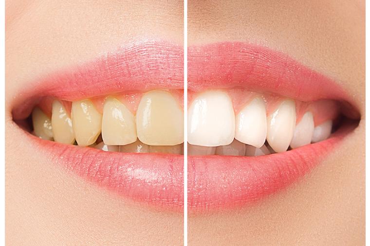 BLISTAV OSMEH BEZ MRLJA: Pogledajte šta može da pomogne kada vam zubi promene boju!