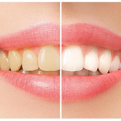 Želite da izbelite zube, a ne možete da priuštite odlazak kod zubara: Evo kako da to uradite kod kuće!