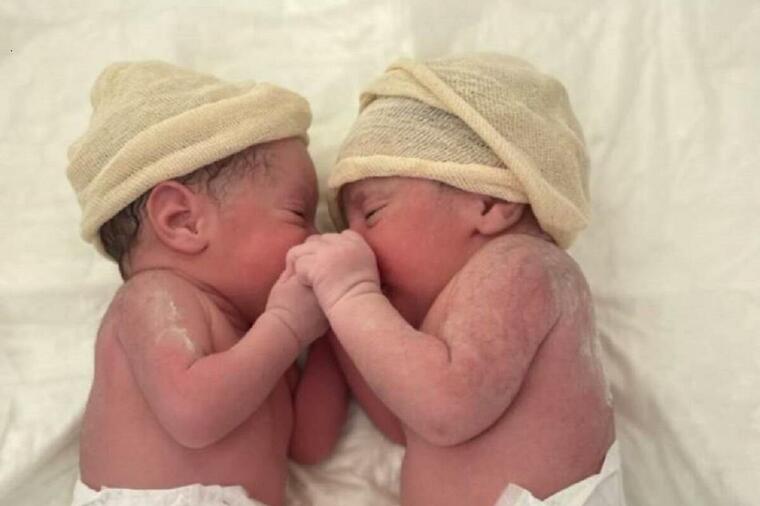 ČUDESNI "POROĐAJ SIRENE" DEŠAVA SE JEDNOM U 80.000 SLUČAJEVA: Ovi neverovatni blizanci iznenadili su medicinsko osoblje