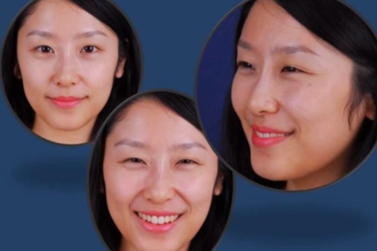 Novi hit plastične hirurgije - večni osmeh (VIDEO)