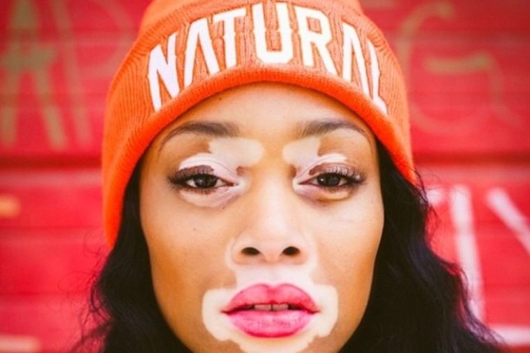 Hrabra i lepa: Manekenka sa vitiligom inspirisala mnoge (FOTO)