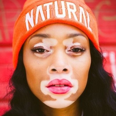 Hrabra i lepa: Manekenka sa vitiligom inspirisala mnoge (FOTO)