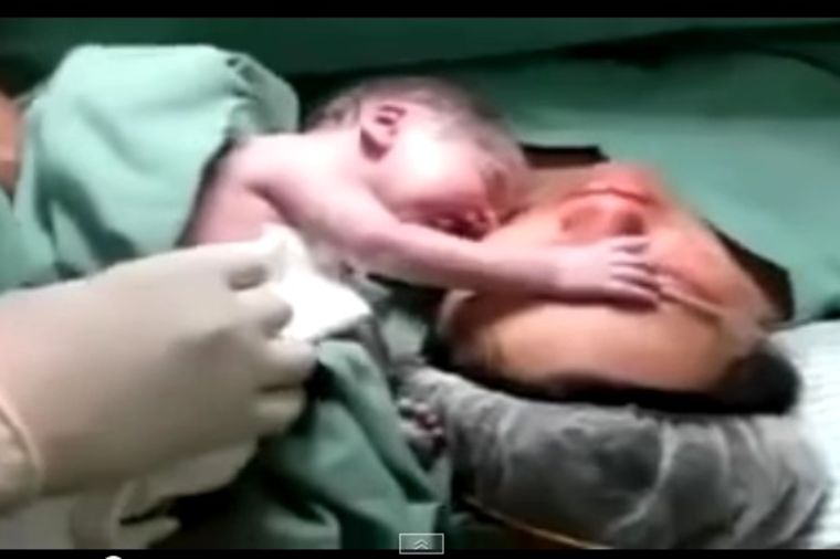 Najdirljiviji momenat rođenja na svetu: Beba ne želi da se odvoji od majke! (VIDEO)