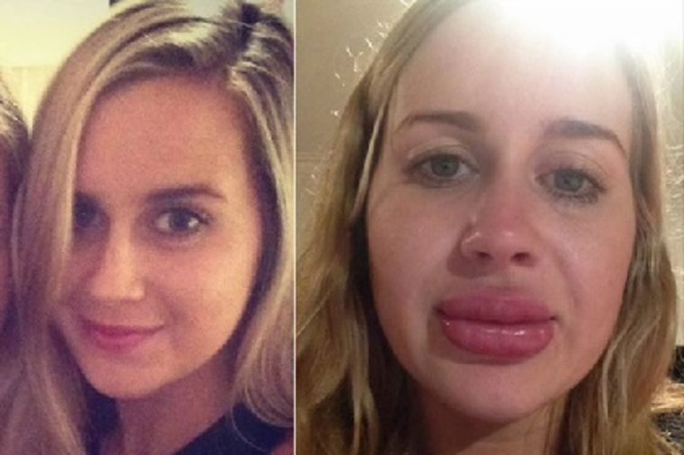 Britani (24) pre i posle povećanja usana: Sada cenim ono što mi je priroda dala! (FOTO, VIDEO)