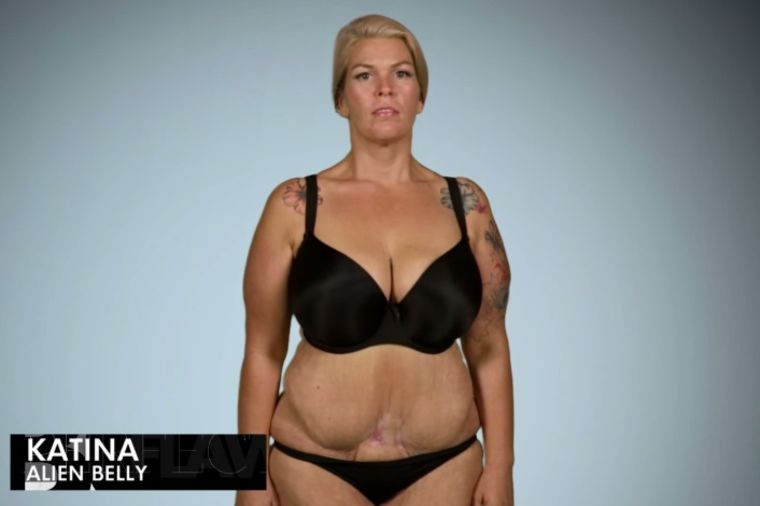 Plastični hirurg je unakazio: Kao da joj je zombi grizao stomak! (FOTO, VIDEO)