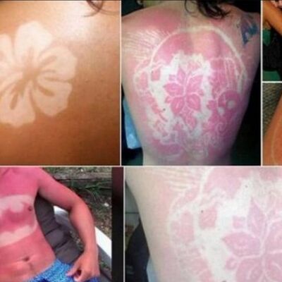 Svesno gore svoju kožu! Rezultat: Opekotine od sunca kao tetovaža! (FOTO)