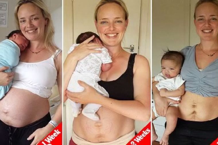 Bez fotošopa i cenzure: Žena pokazala kako stvarno izgleda telo posle porođaja! (FOTO, VIDEO)