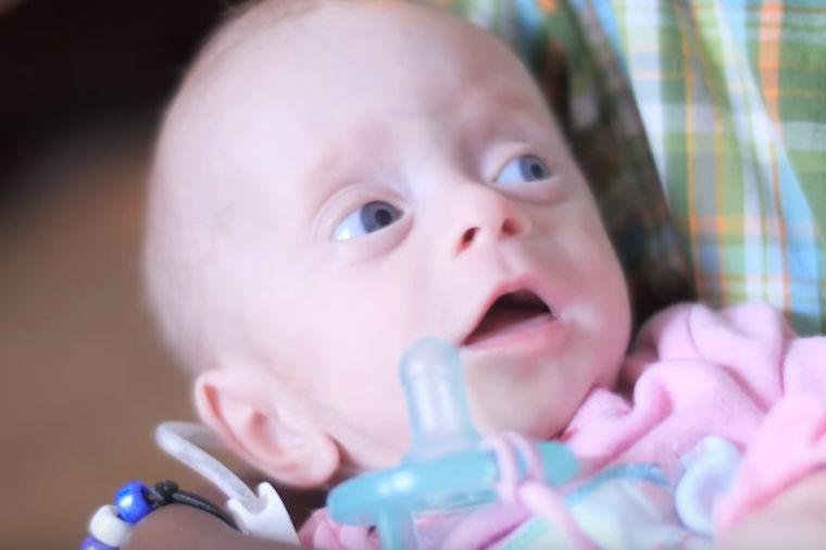 Usvojili bebu bez mozga iz neverovatnog razloga: Dirljiva priča za pamćenje! (VIDEO)