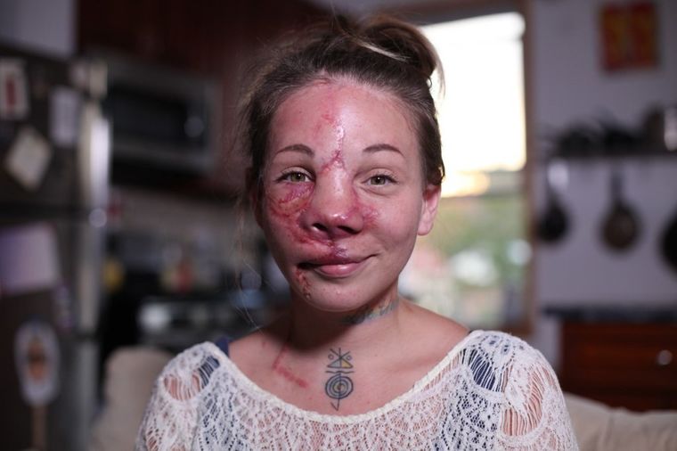Ugradili joj balone u lice: Žena (29) prošla kroz pravi pakao! (FOTO)
