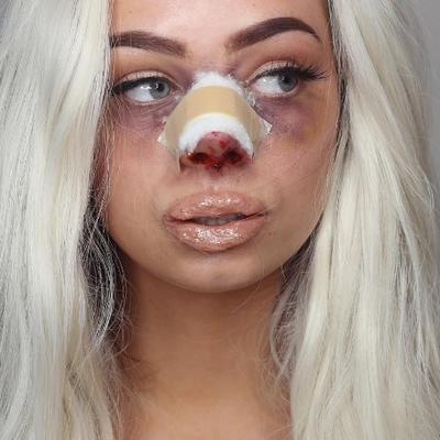 Jeziva cena plastične lepote: Ovako lice izgleda nakon estetskih operacija! (FOTO, VIDEO)