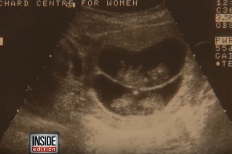 Ultrazvuk bliznakinja izgledao sasvim obično: Zapanjile sve kada su se rodile! (VIDEO)