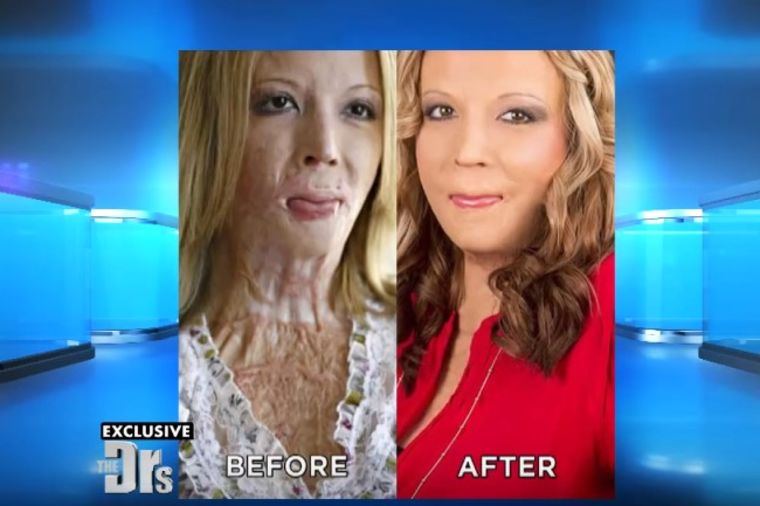 Muž pretukao i zapalio ženu: Sedam godina kasnije, njena transformacija je neverovatna! (VIDEO)