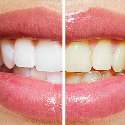 Holivudski osmeh za 14 dana: Kako da vam zubi postanu blistavo beli!