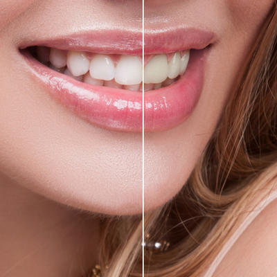 Bez skupih preparata: Uklonite zubni kamenac i izbelite zube kod kuće! (RECEPT)