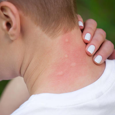 SIMPTOMI VIRUSA ZAPADNOG NILA: Ako vas ujede zaražen komarac, evo šta treba da uradite odmah