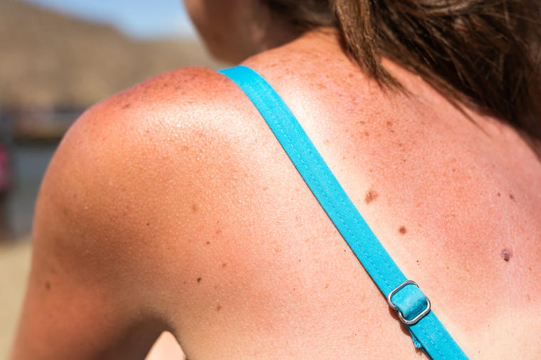 Preplanuo ten bez mnogo muke: Pet načina da što brže oporavimo kožu od opekotina od sunca!