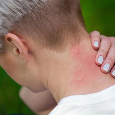 8 opakih bolesti koje prenose komarci: Ovo su simptomi i teške posledice!
