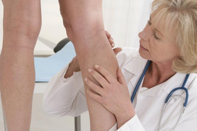 Ovo su 3 glavna uzroka varikoznih vena: Kad se pojave na nogama, bolest je već u završnoj fazi!