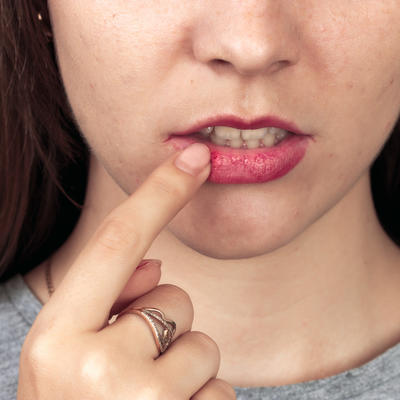 Oslobodite se herpesa na usnama za jedan dan: Evo kako! (RECEPT)