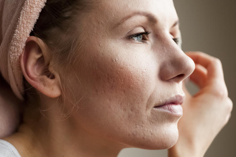 Rešenje iz prirode za ožiljke od akni: Ukoliko imate neravnine na licu možete ih vrlo lako ublažiti