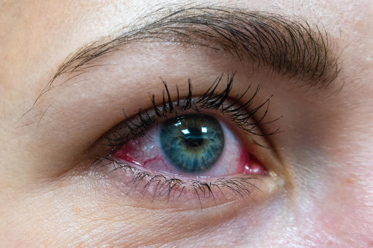 Ovaj znak ne smete ignorisati: Crvenilo očiju može da bude prvi simptom ove bolesti!
