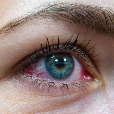 Oči jasno govore da imate korona virus - tvrde američki lekari: Ova dva simptoma nisu bezazleni!