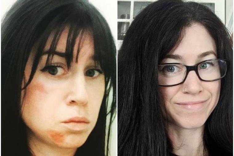 Godinama nije mogla da izađe na kraj sa aknama: Imala je ožiljke po licu, a onda je karantin promenio sve! (FOTO)
