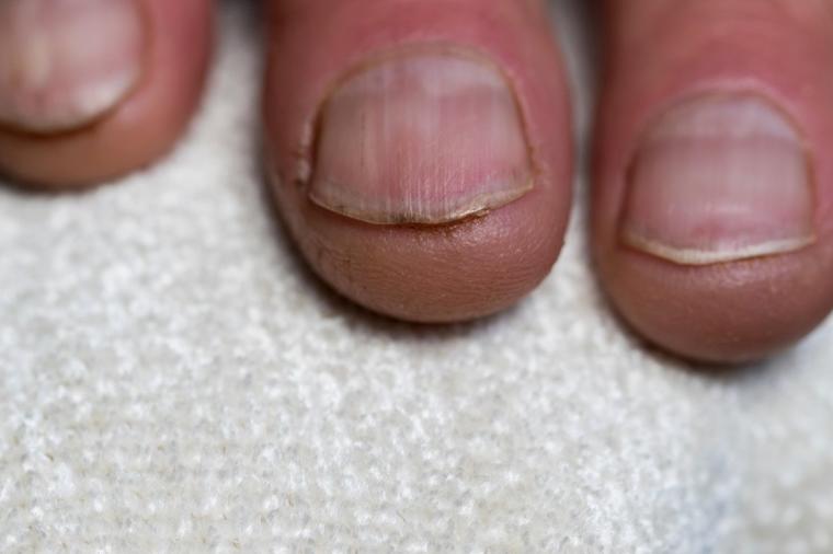 Gljivice na noktima mogu ozbiljno narušiti zdravlje: Ova 3 domaća leka uspešno suzbijaju infekciju! (RECEPT)