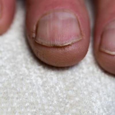 Gljivice na noktima mogu ozbiljno narušiti zdravlje: Ova 3 domaća leka uspešno suzbijaju infekciju! (RECEPT)