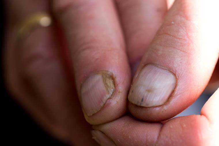 Evo kako da očistite nokte od gljivica: Posle ovog bolest se ne širi i ne vraća!