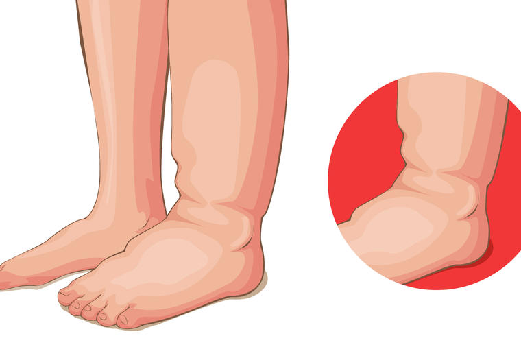 6 uzročnika edema: Ako vam natiču ruke, noge ili lice, evo šta se dešava sa vašim telom!