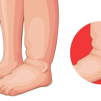 6 uzročnika edema: Ako vam natiču ruke, noge ili lice, evo šta se dešava sa vašim telom!