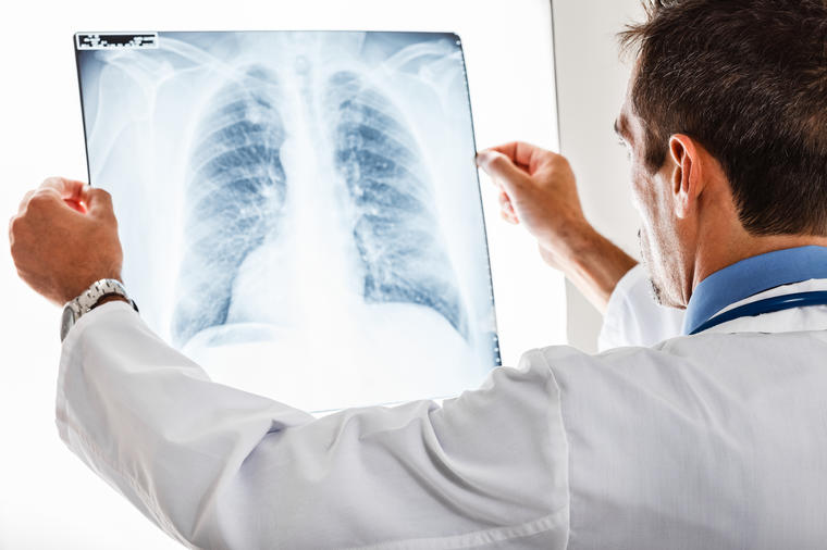 ISPRAVKA: Žutica nije jasan signal da se u telu razvija rak pluća