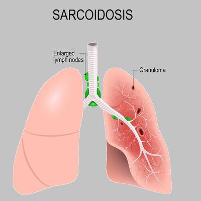 Sarkoidoza: Ovo su prvi simptomi neizlečive plućne bolesti!