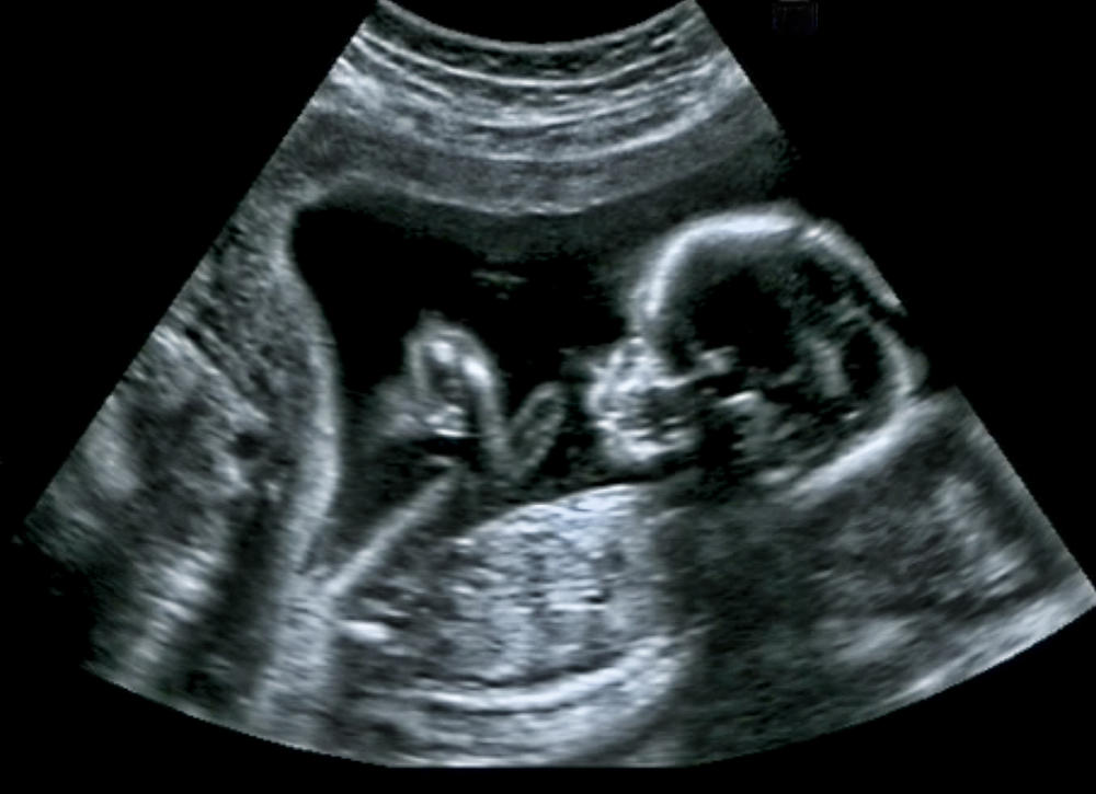 Slika bebe na ultrazvuku 